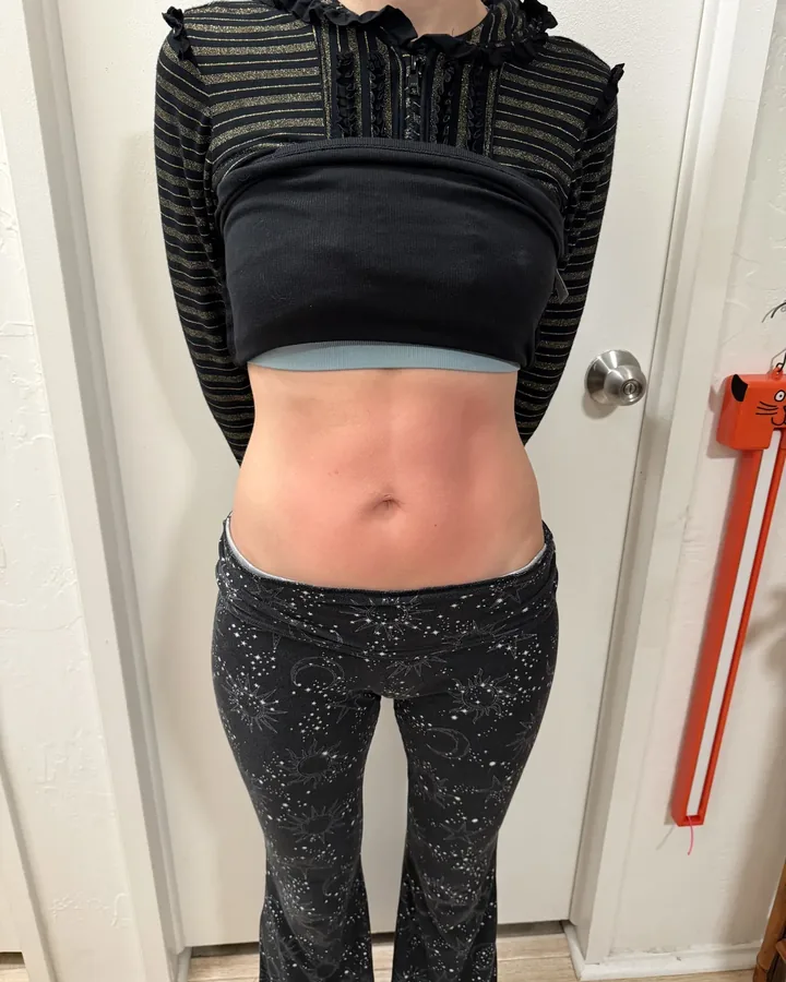 Front view of the same client's abdomen after one body-sculpting session