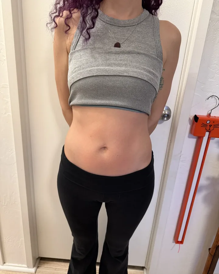 Front view of a client's abdomen before one body-sculpting session