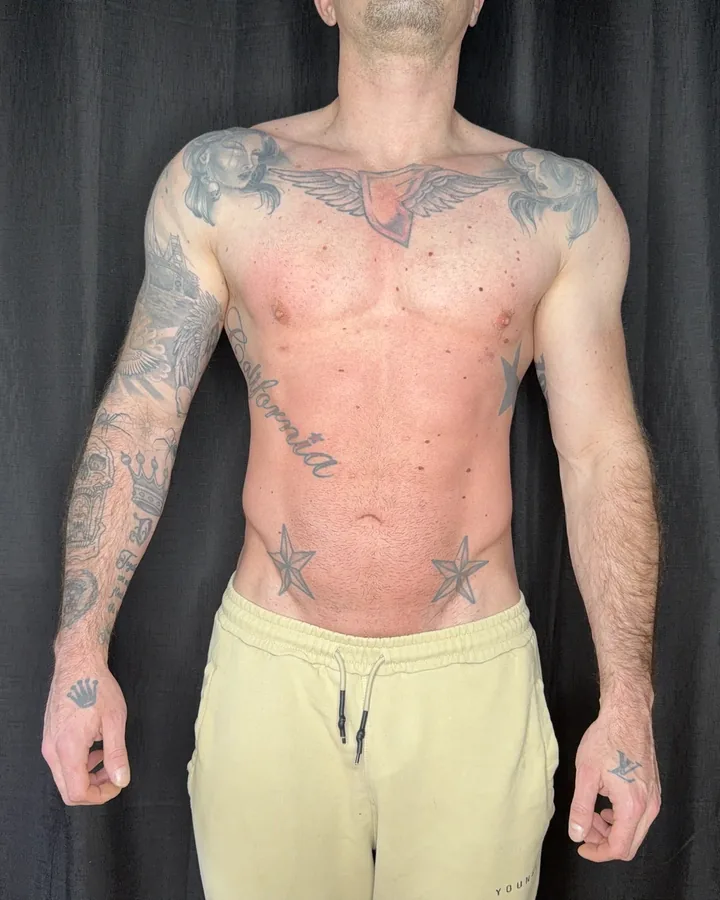 Front torso view after one body-sculpting session