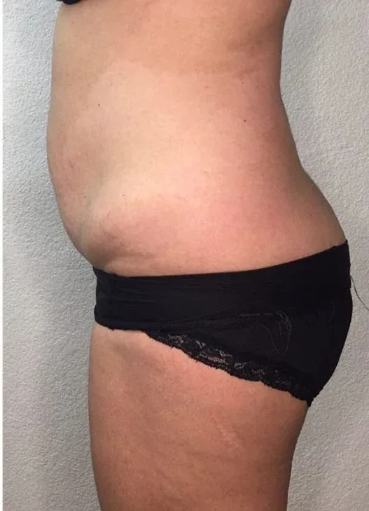Side profile after a three-session abdominal contouring series