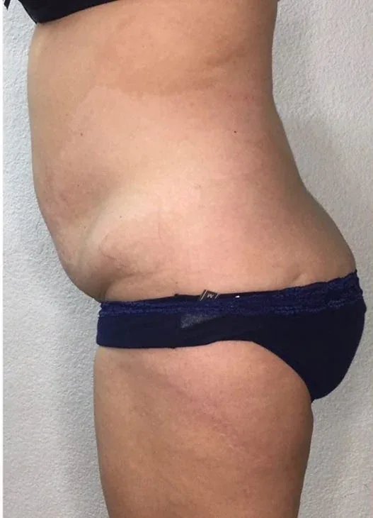 Side profile before a three-session abdominal contouring series