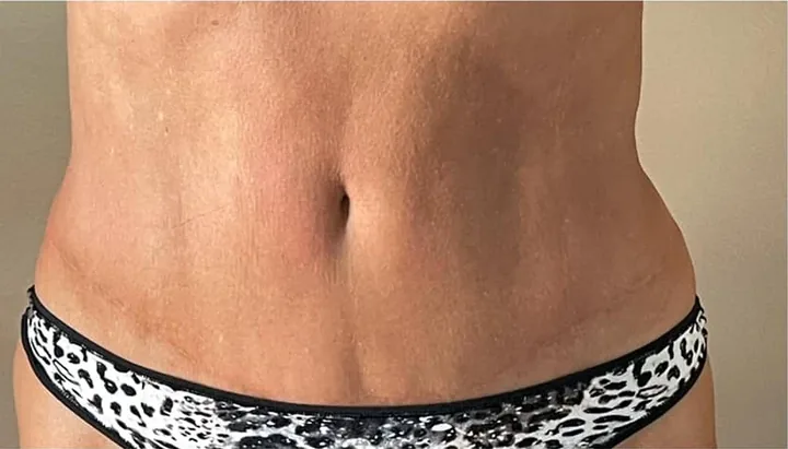 Front view of the same abdomen after a two-session body-sculpting series