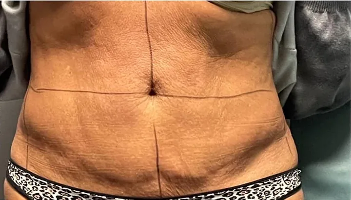 Front view of an abdomen before a two-session body-sculpting series