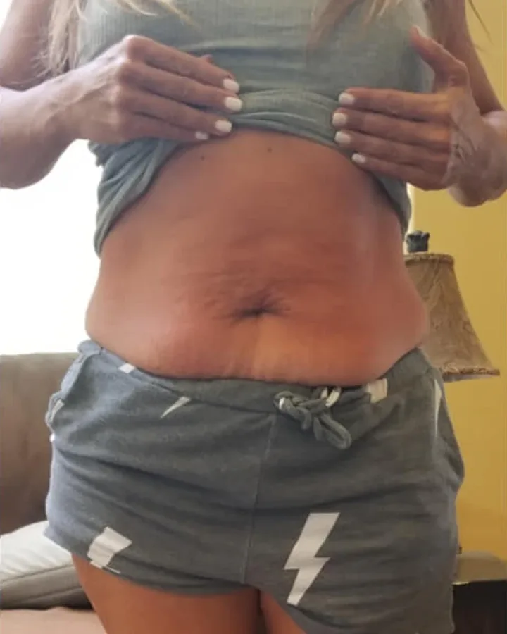 Abdomen after one body-sculpting session