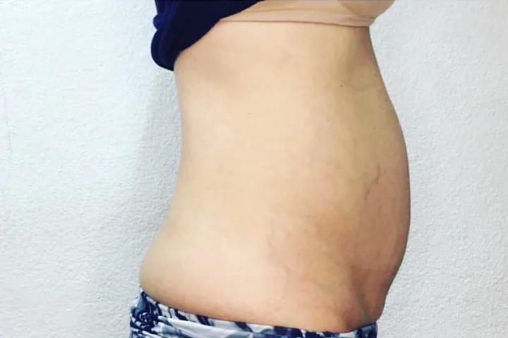 Abdomen before a three-session body-sculpting series