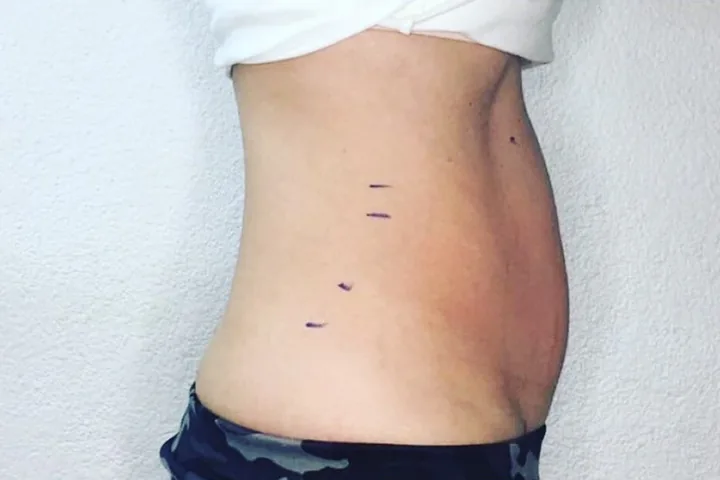 Abdomen during a three-session body-sculpting series