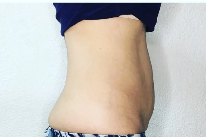 Abdomen after a three-session body-sculpting series