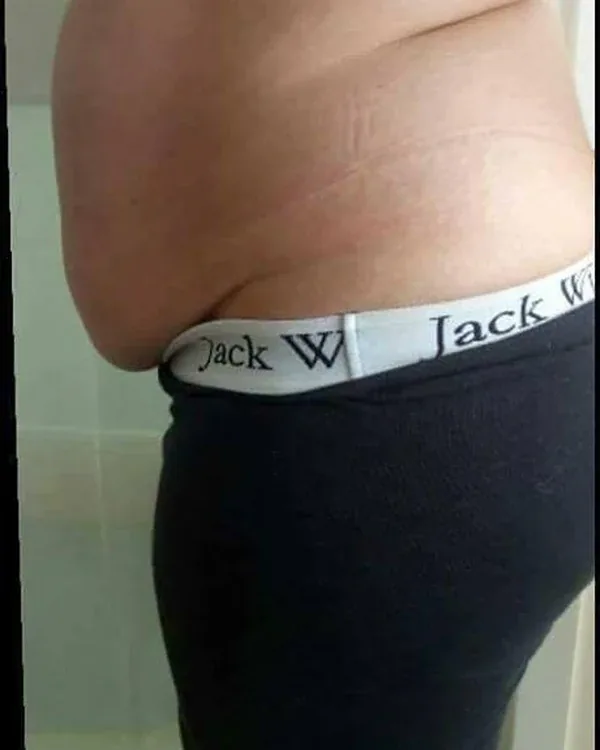 Side view of an abdomen before one skin-tightening session