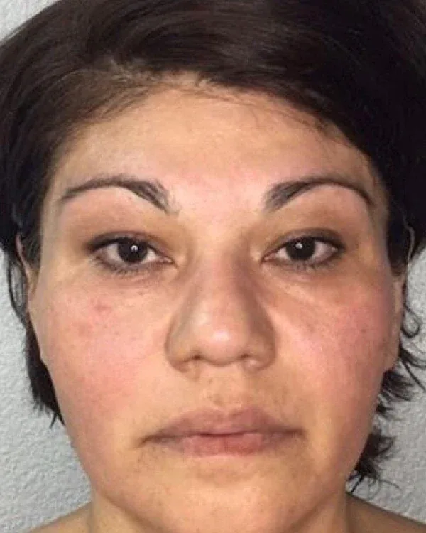 Face after a four-session facial cryotherapy series