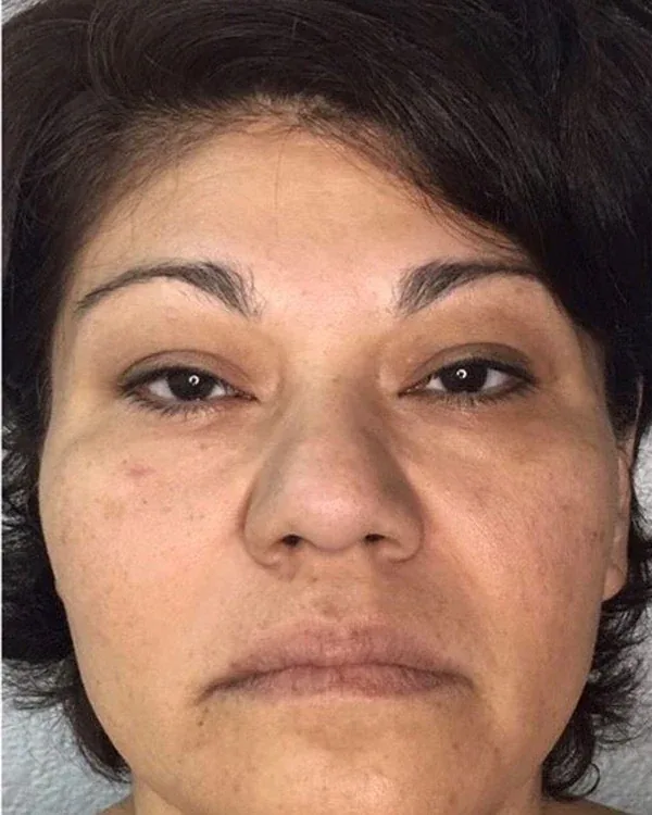 Face before a four-session facial cryotherapy series