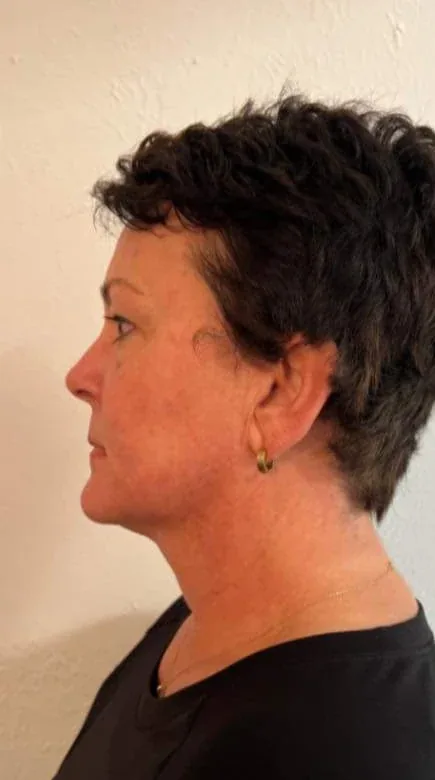Side profile after a facial and neck cryotherapy treatment