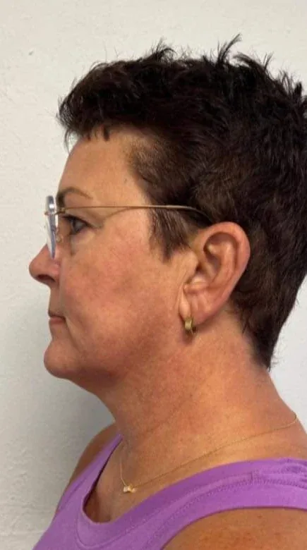 Side profile before a facial and neck cryotherapy treatment