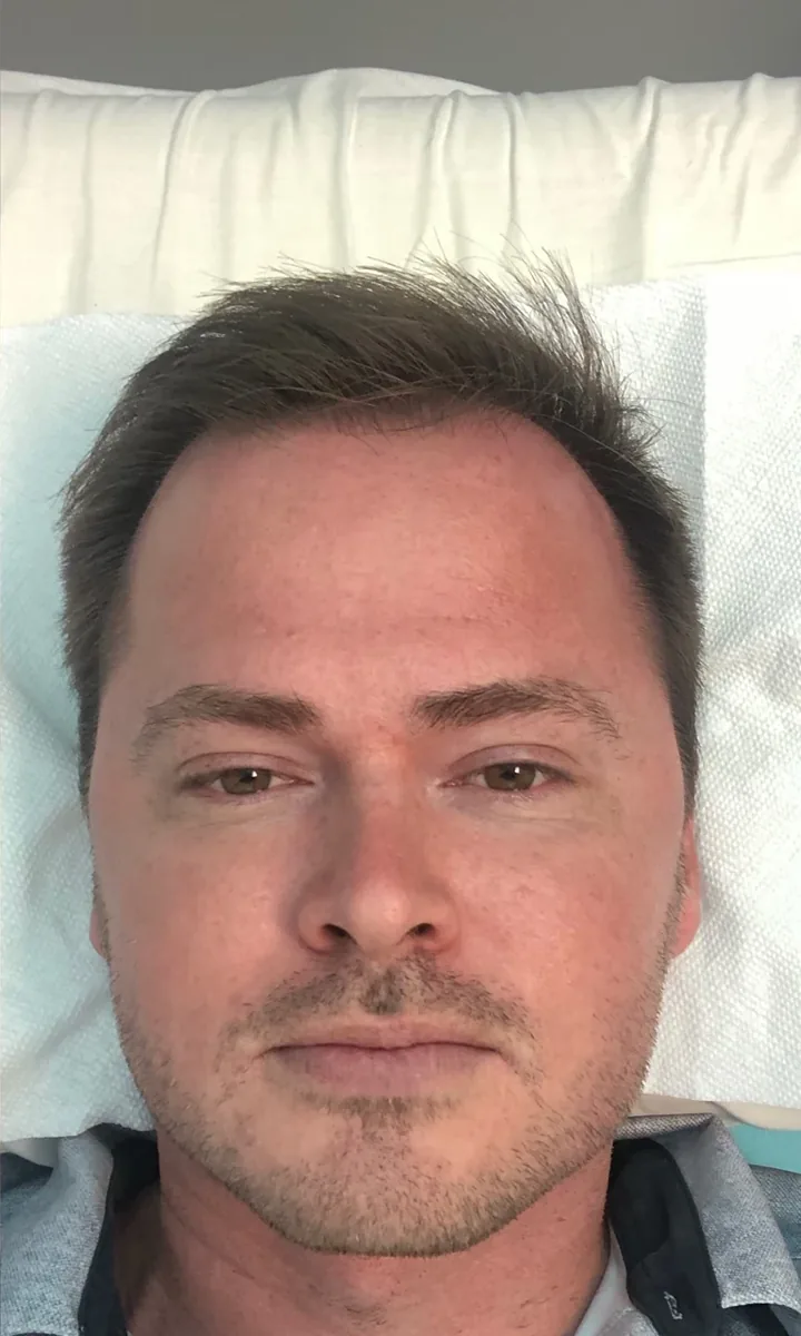 Front view after a facial and jawline cryotherapy treatment