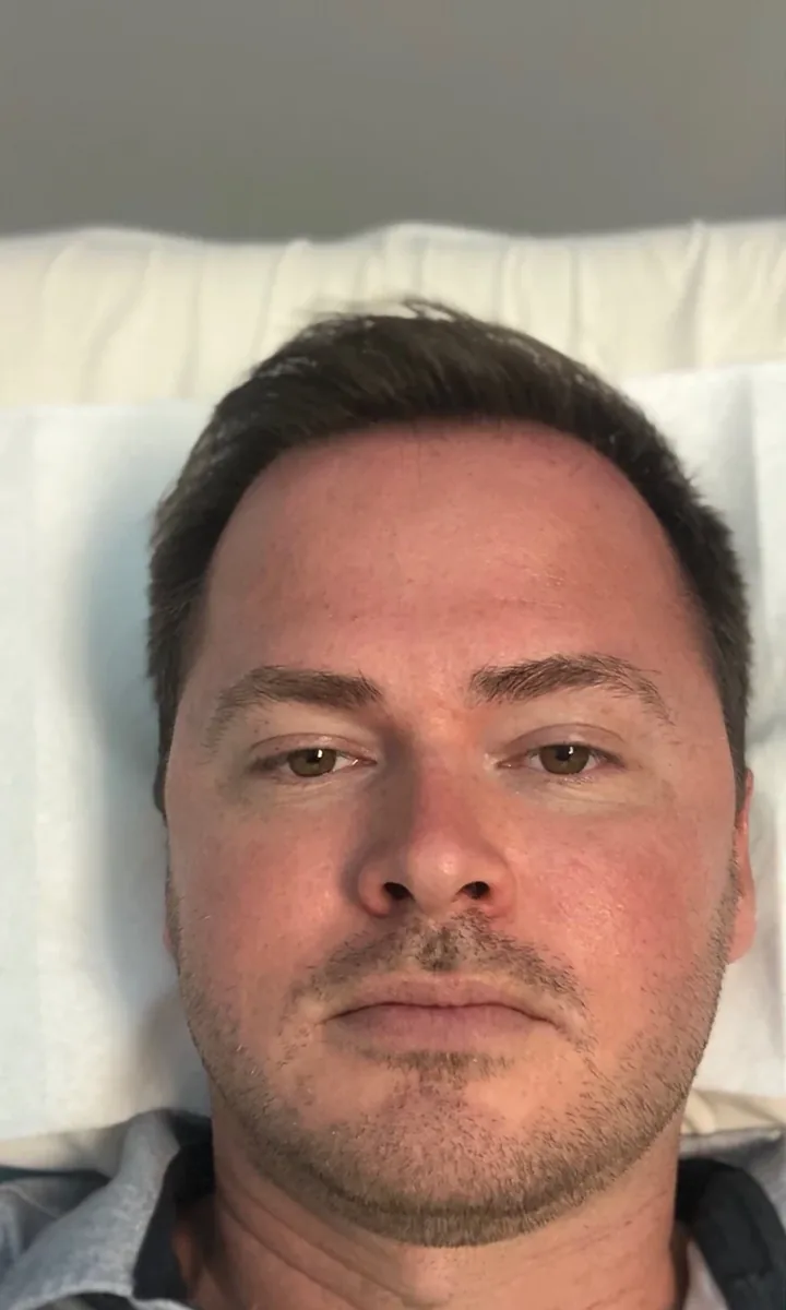 Front view before a facial and jawline cryotherapy treatment