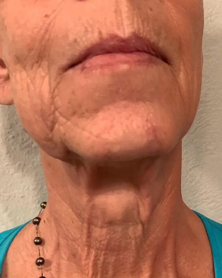 Neck and jawline after skin-tightening cryotherapy