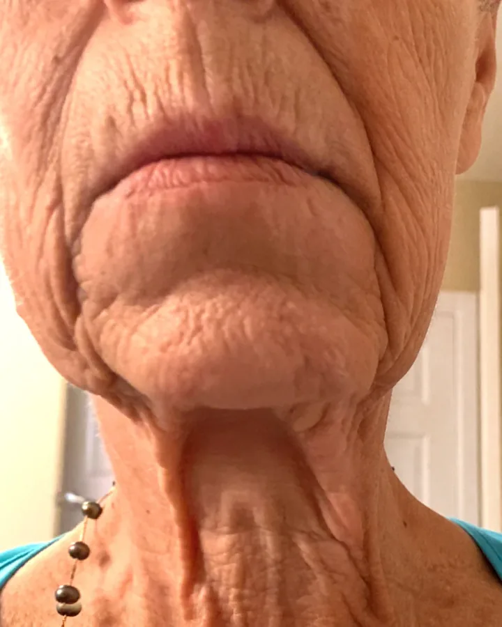 Neck and jawline before skin-tightening cryotherapy