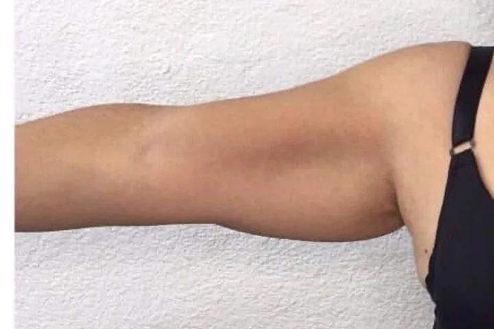 Upper arm before a three-session body-sculpting series