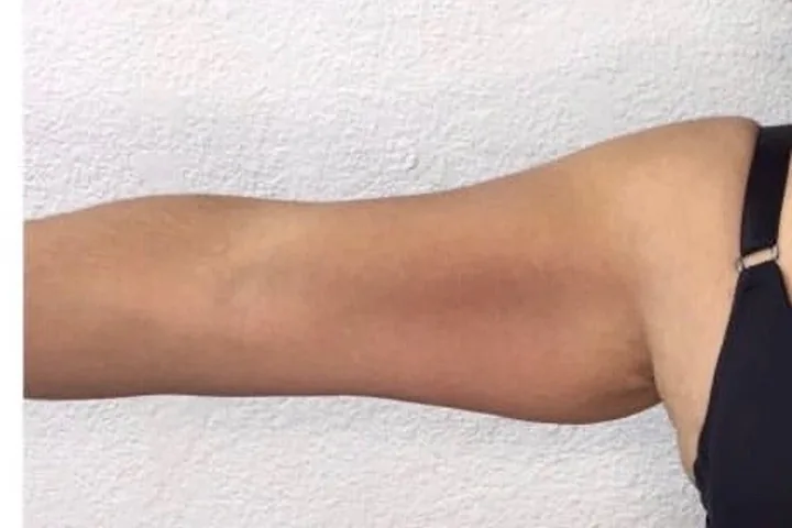 Upper arm during a three-session body-sculpting series