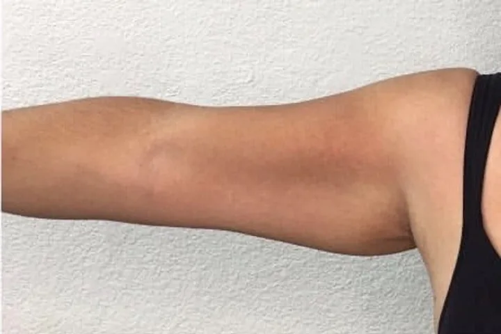 Upper arm after a three-session body-sculpting series
